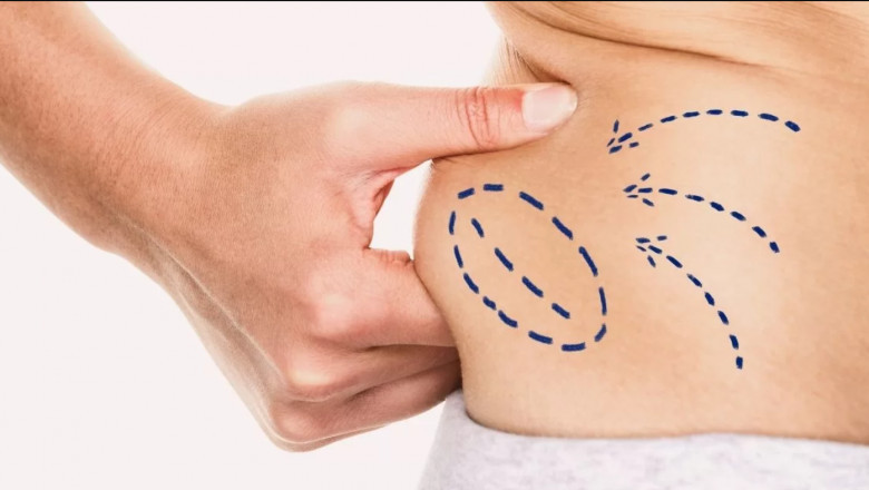Cherish the Journey Highlighting Liposuction Milestones in Dubai