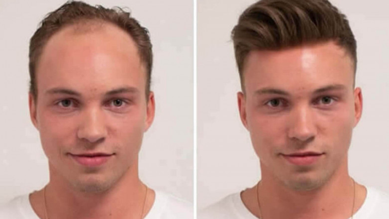 Men’s Hair Replacement: Best Solutions for a Fuller Look