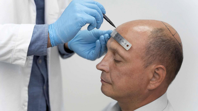 زراعة الشعر دبي