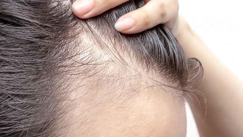 Can a Hair Specialist Doctor Provide Relief for Thinning Hair?