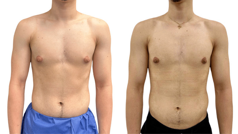 Flat Chest, Full Confidence: Beating Gynecomastia for Good