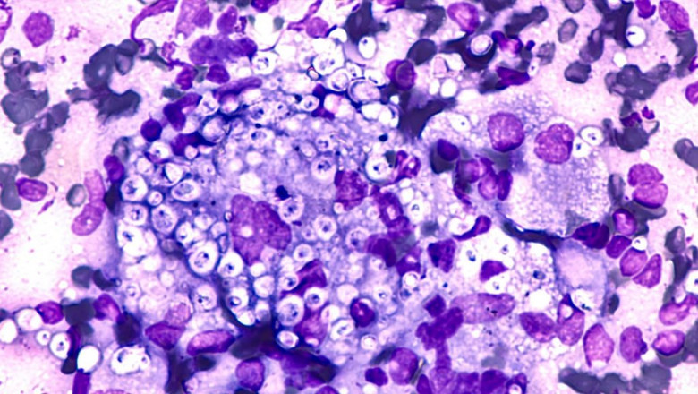 Histoplasmosis Treatment Market to Grow Fast with Novel Antifungals