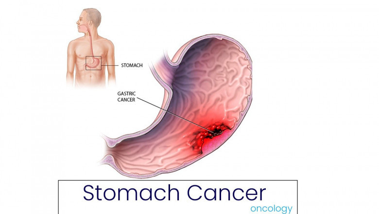 Looking for a GI Cancer Surgeon in Bangalore? Choose Dr. Bhushan