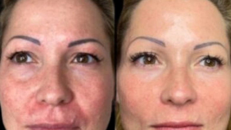 Safety and Effectiveness of Profhilo at the Best Aesthetic Clinic in Dubai