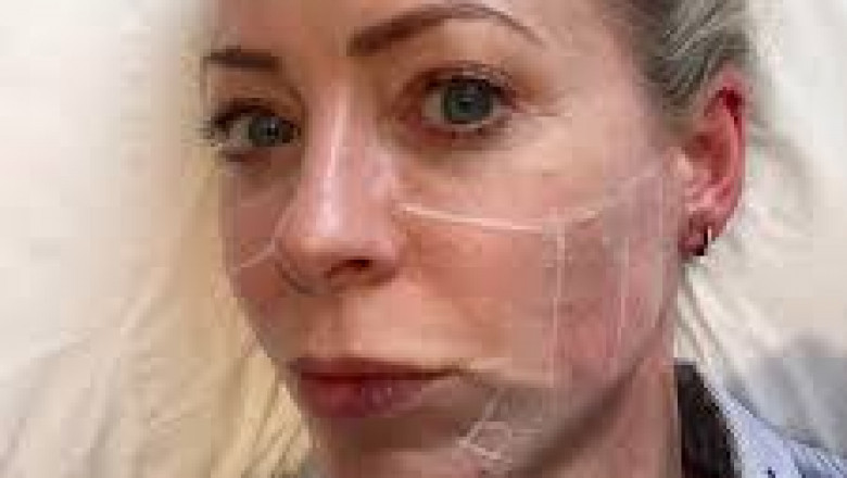 Ultherapy for Under-Eye Skin Tightening: Does It Work?