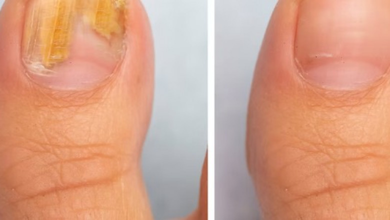 When to Seek Professional Nail Fungus Treatment in Singapore