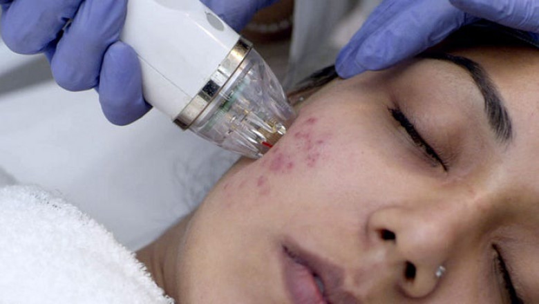 Acne Scar Treatment in Delhi — Clearer Skin, Renewed Confidence