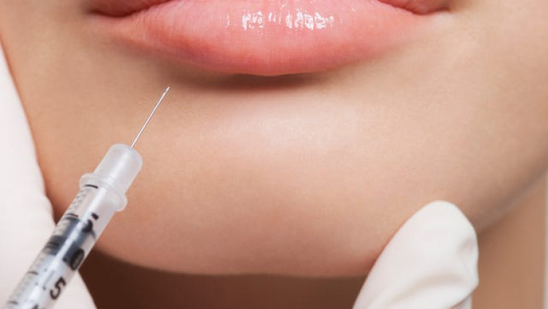 Are There Natural-Looking Lip Filler Options?