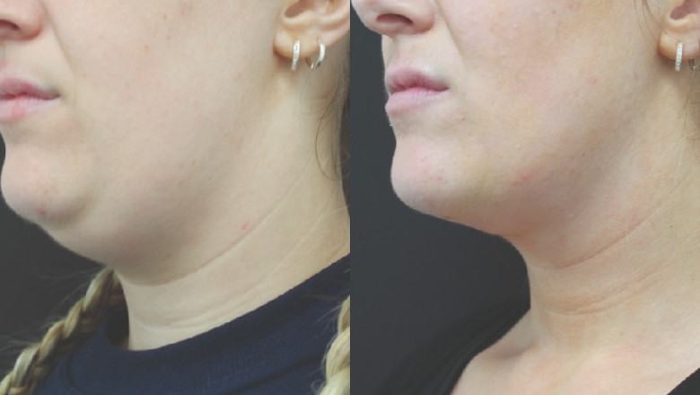 Exploring Chin Liposuction