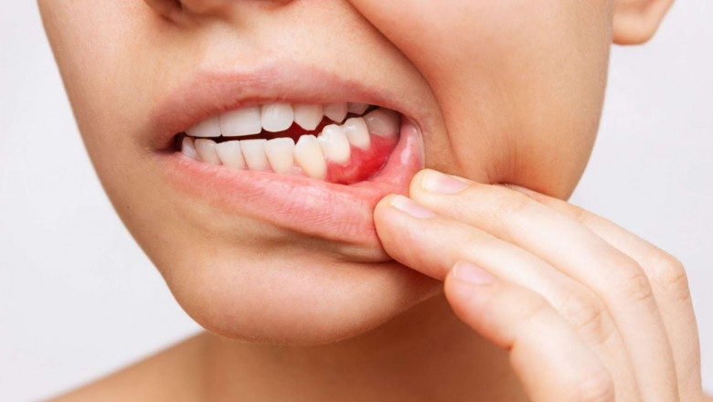 Gingival Recession Market is Anticipated to Witness High Growth Owing to Rising Periodontal Disease Incidence