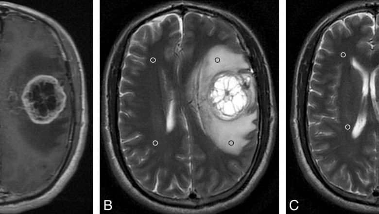 Glioblastoma Market is Anticipated to Witness High Growth Owing to Immunotherapy Innovations