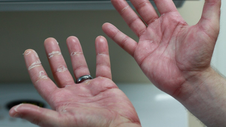 Hand Foot Syndrome Market to Surge Due to Rising Chemotherapy-Induced Cases