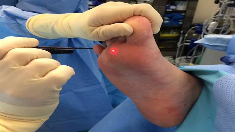 How to Prevent Warts After Treatment