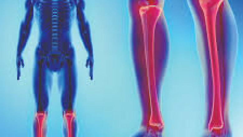 Limb Lengthening Surgery in Japan: Rising Demand, Advanced Techniques, and Market Insights