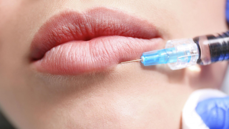 Lip Filler Market Trends Shaping the Future of Non-Invasive Aesthetic Treatments Worldwide