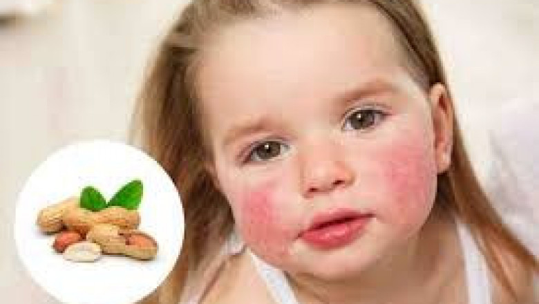 Oral Immunotherapy for Peanut Allergies in Adults: A Breakthrough in Allergy Treatment