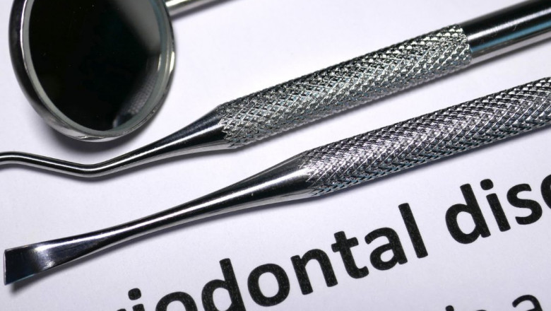The 4 Stages of Periodontal Disease: Causes, Symptoms, and Treatments
