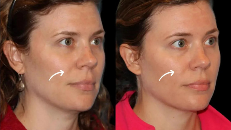 Celebrity-Endorsed Best Plastic Surgeons in Dubai: Who They Trust for Sculptra Fillers