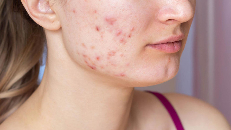 Acne Treatment Without Harsh Side Effects in Dubai