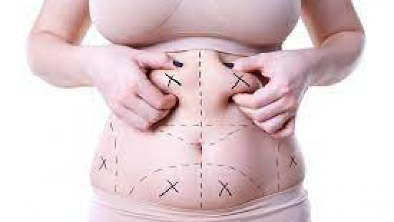 Does Liposuction Help with Weight Loss? Expert Insights