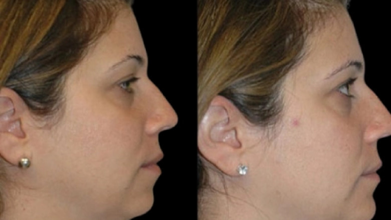 Is Double chin removal in dubai Safe? What You Need to Know