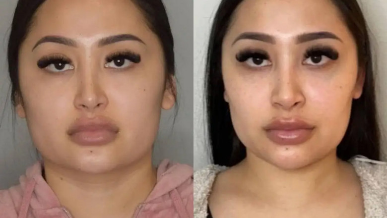 What Your First Consultation for Buccal fat removal in Dubai Will Be Like