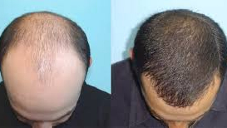 Hair Transplant Myths vs. Facts: Separating Truth from Misconception in 2025