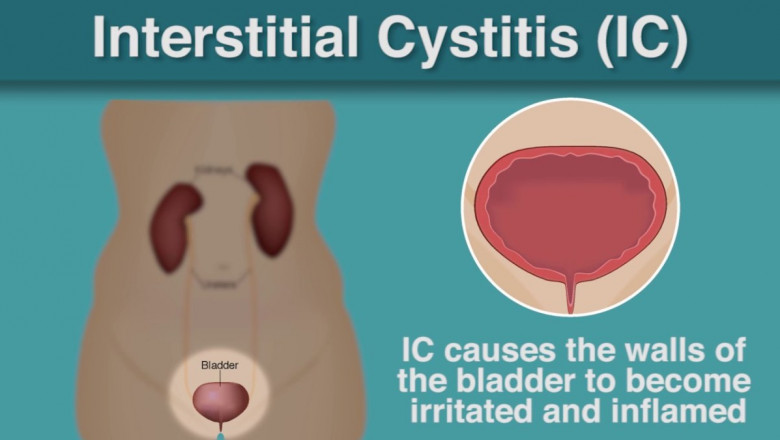 Acupuncture for Interstitial Cystitis