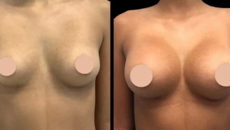 Breast Augmentation in Dubai: A Look at Recovery Times and Expectations
