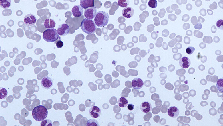 Chronic Myelomonocytic Leukemia Market to Soar on Precision Therapies