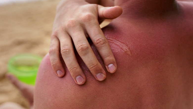 Keloid Market Trends and Future Insights: Key Opportunities and Growth Drivers