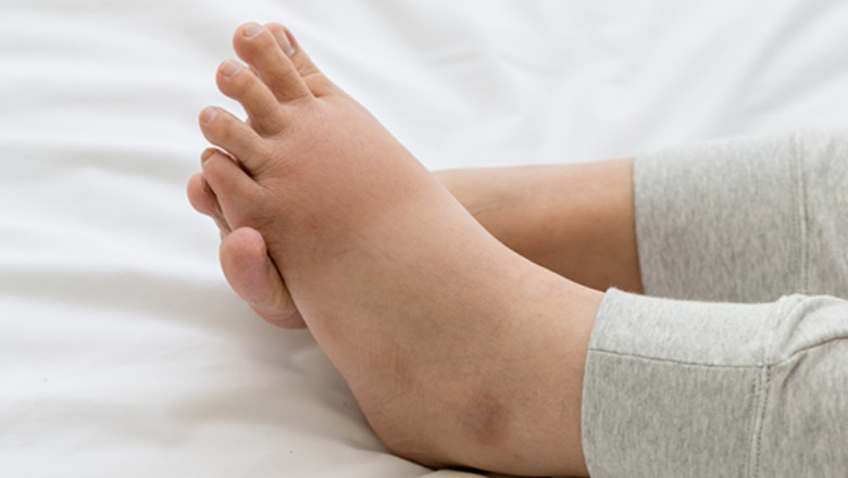 Legs Feeling Like Balloons? These Supplements for Leg Swelling Might Be the Secret You Need