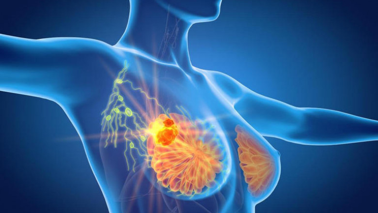 Metastatic Triple-Negative Breast Cancer (mTNBC) Market Propelled by Targeted Therapies