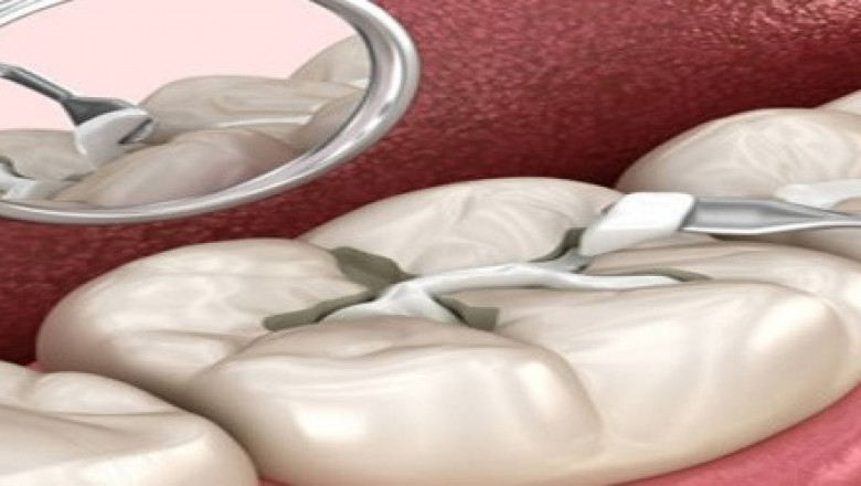 Root Canal Treatment in Tampa, FL: A Complete Patient Guide