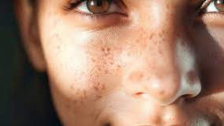 What Causes Melasma and How Can You Treat It?