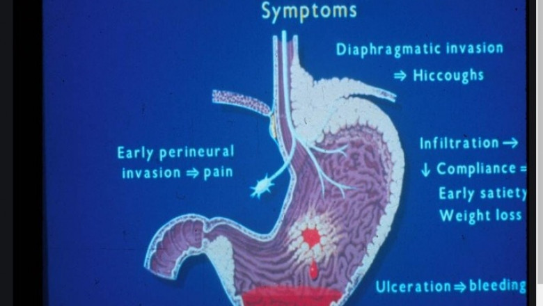 Laparoscopic GI Cancer Surgery in Bangalore by Dr. Bhushan Chittawadagi