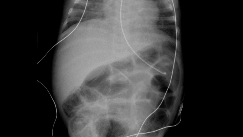 Necrotising Enterocolitis Market to Grow on Rising Preterm Births