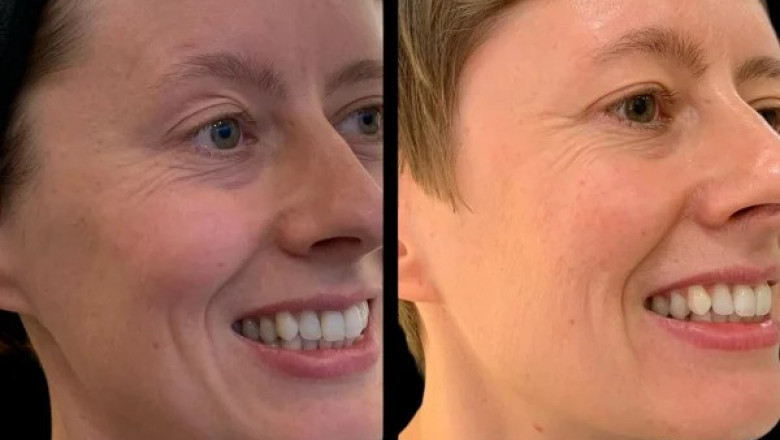 The Science Behind Profhilo Treatments in Dubai: How It Works to Revitalize Your Skin