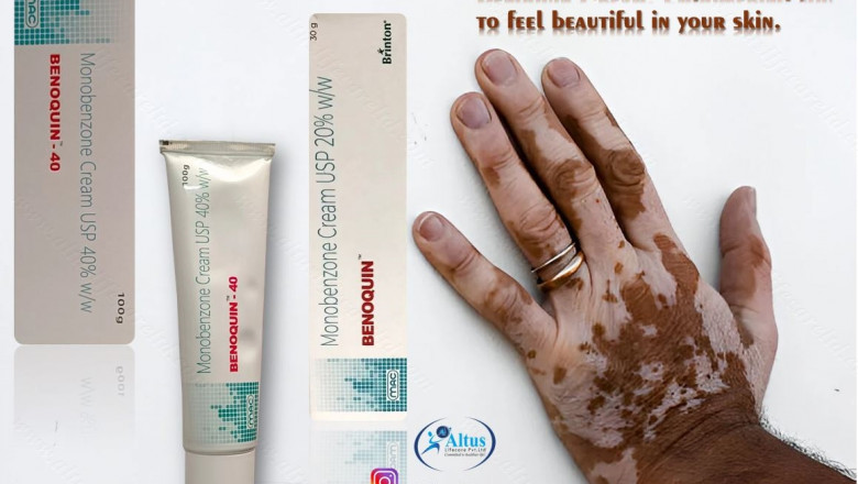 Benoquin Cream 20 A Breakthrough for Vitiligo Treatment!