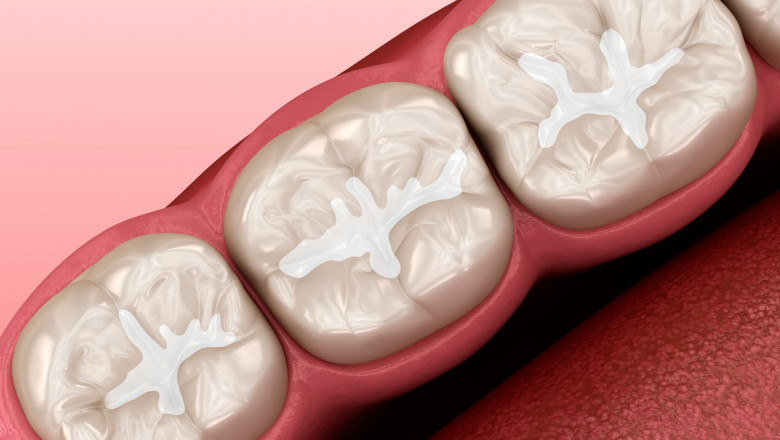 Dental Sealants Market: How Government Initiatives and Innovations Are Fueling Market Growth