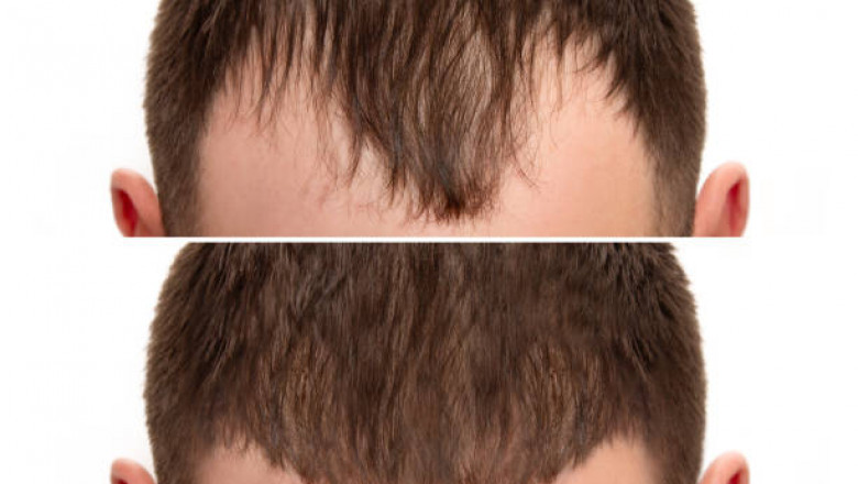 Hair Today, Here Tomorrow: Long-Term Results of Riyadh’s Leading Transplant Clinics