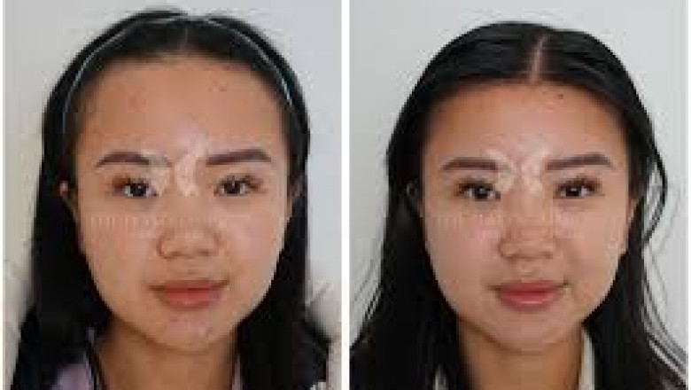 Hairline Lowering vs. Scalp Reduction: Which Hair Surgery Is Right for You?