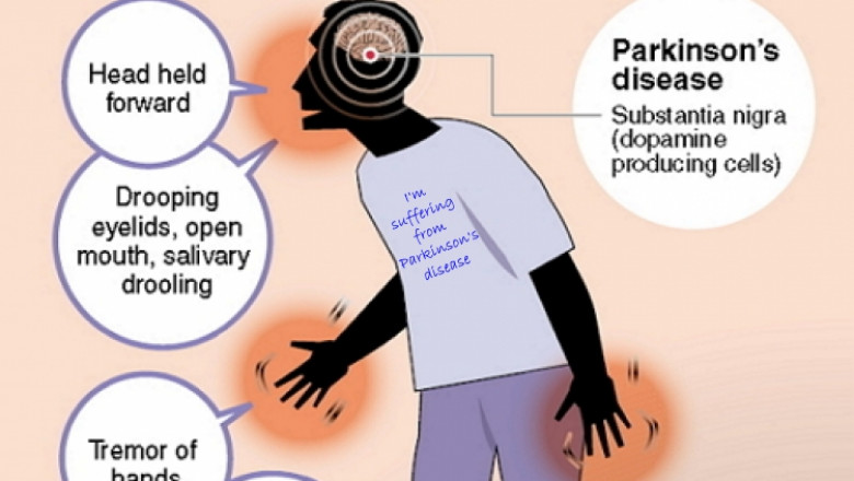 Parkinson's Disease Treatment - Philadelphia Holistic Clinic - Dr. Tsan