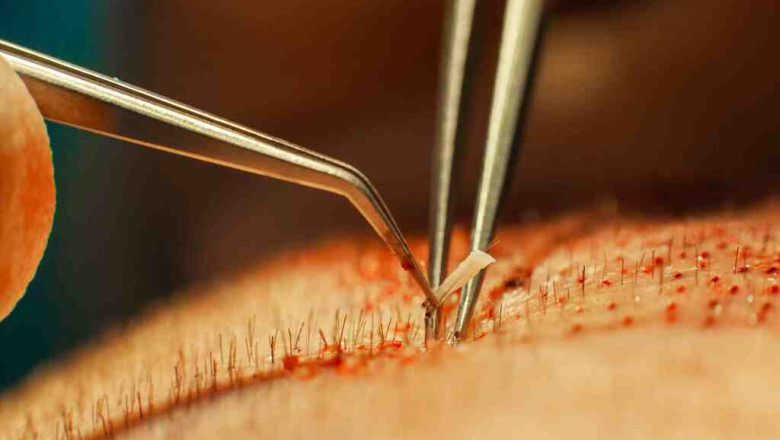 Understanding How Hair Transplant Works And Its Advantages