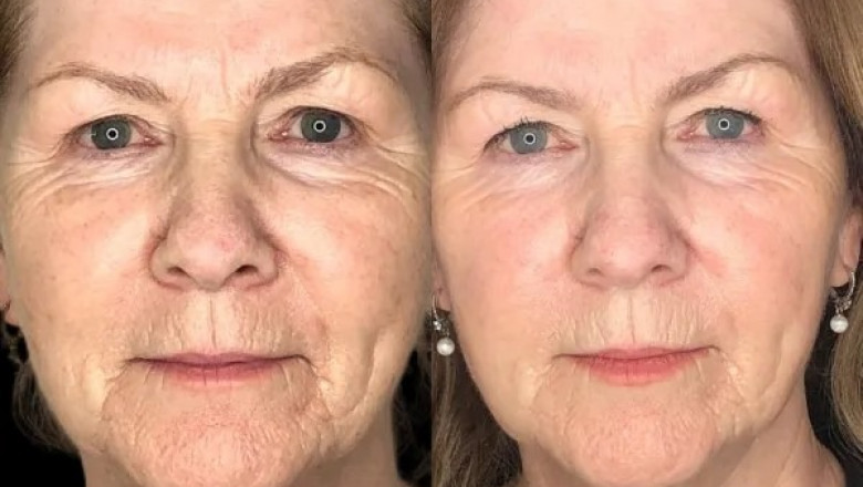 Claim Your Radiance with Profhilo from the Best Doctors in dubai