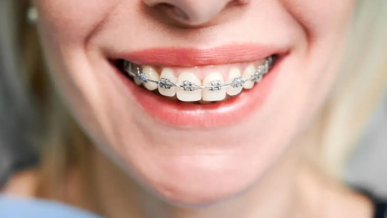 Find the Best Braces in Dubai for a Stunning Smile