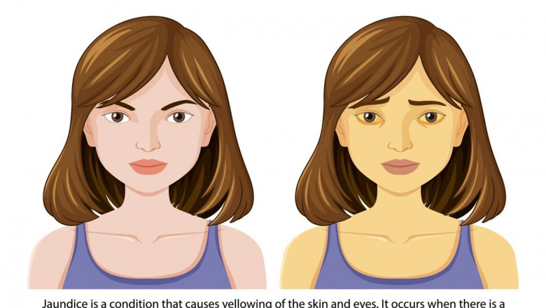 Jaundice: Causes, Symptoms, Western and Holistic Treatments