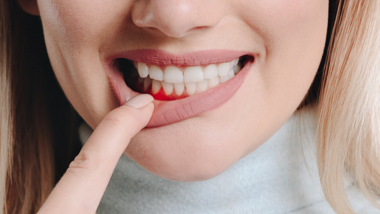 Regional Insights into the Gingivitis Treatment Industry Outlook 2025 to 2035