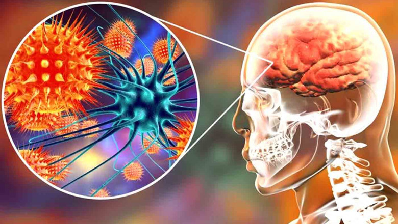 Autoimmune Encephalitis Treatment Market Boosted by Monoclonal Antibody Therapies
