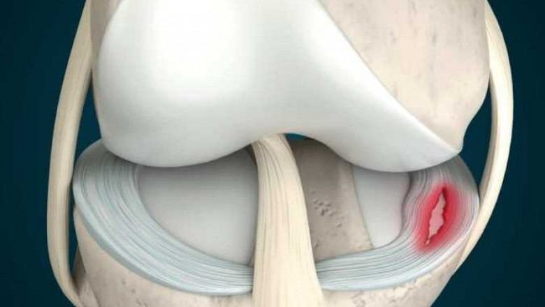Best Meniscus Tear Treatment In Delhi NCR.